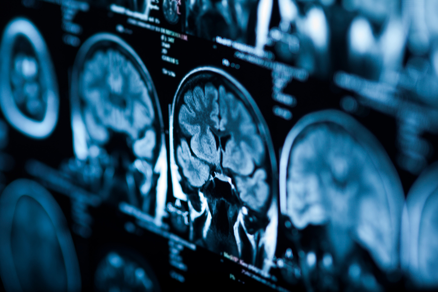 il-glioblastoma-multiforme-una-sfida-aperta-alla-ricerca-di-terapie-efficaci