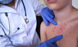 impetigine-nei-bambini-e-negli-adulti-cause-sintomi-cure-e-prevenzione
