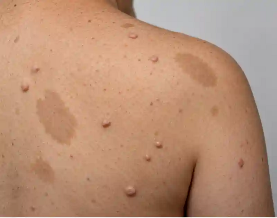 neurofibromatosi-di-tipo-1-nuove-terapie-per-i-neurofibromi-plessiformi