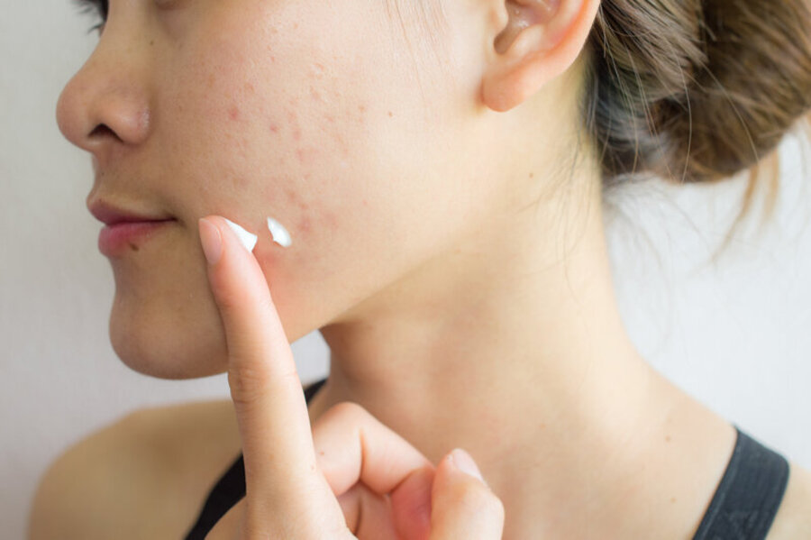 Quali farmaci si usano per trattare l’acne?